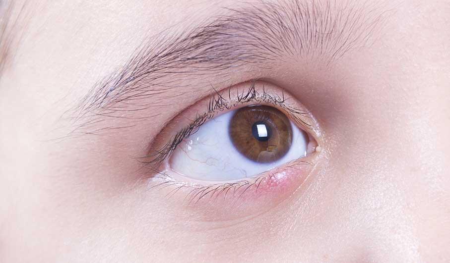 lower eyelid edema